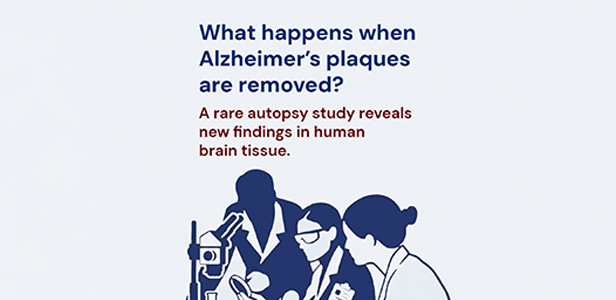 An illustration of researchers below text that reads: What happens when Alzheimer’s plaques are removed? A rare autopsy study reveals new findings in human brain tissue.